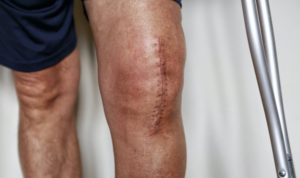 What Does The Scar Look Like After Knee Replacement