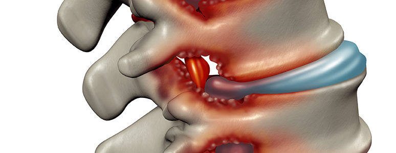 Understanding Spinal Stenosis: Orthopedic & Wellness : Pain Management