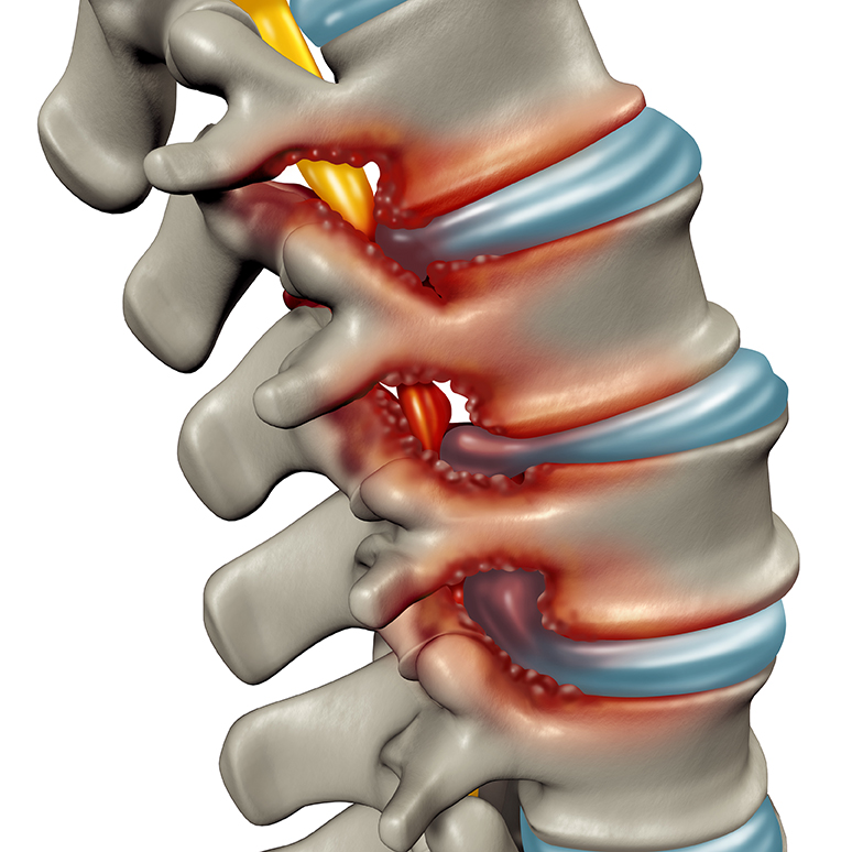 What Is Spinal Stenosis and How Is It Treated?