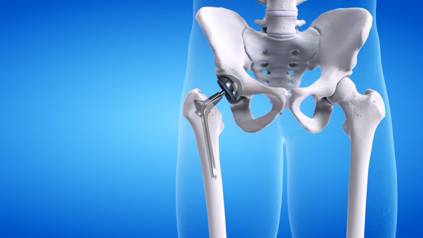 Common Signs You Need a Hip Replacement
