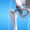 From Surgery to Strength: Understanding the Hip Replacement Recovery Timeline