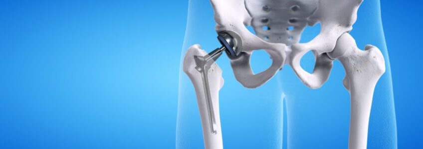 hip replacement recovery timeline